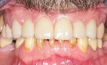 Flawlessly repaired top teeth