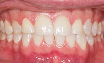 Teeth before whitening