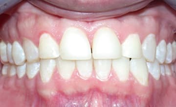 Teeth after whitening