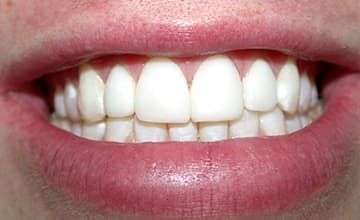 White healthy front teeth