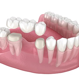 Render of a dental bridge in Brampton, ON