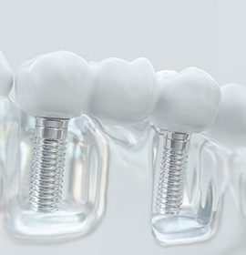A dental bridge in Brampton, ON supported by dental implants