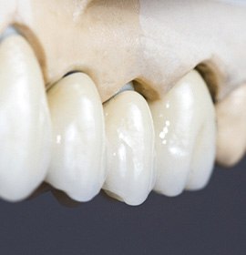 Dental bridges on a model of teeth