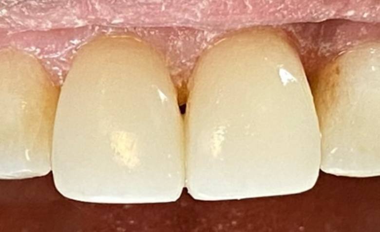 Flawlessly repaired top teeth