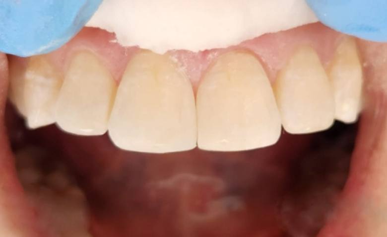 Flawlessly repaired top teeth