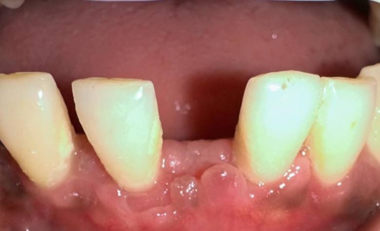 Flawlessly repaired top teeth