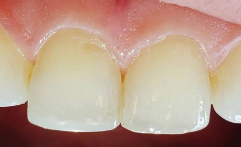 Flawlessly repaired top teeth