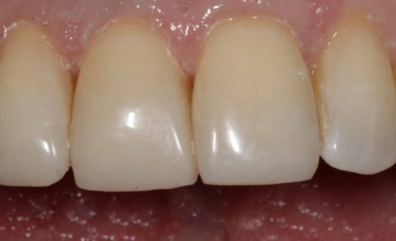 Flawlessly repaired top teeth