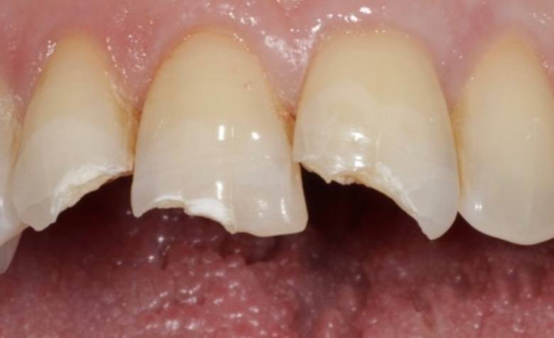 Decayed and broken top teeth