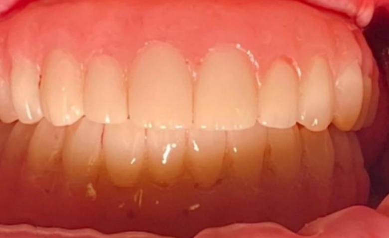 Flawlessly repaired top teeth