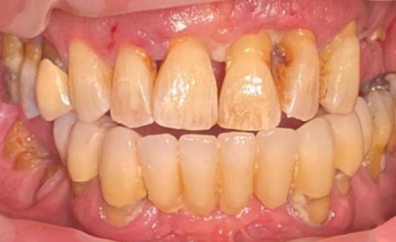 Decayed and broken top teeth