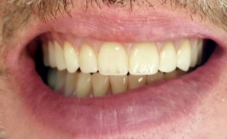 Flawlessly repaired top teeth