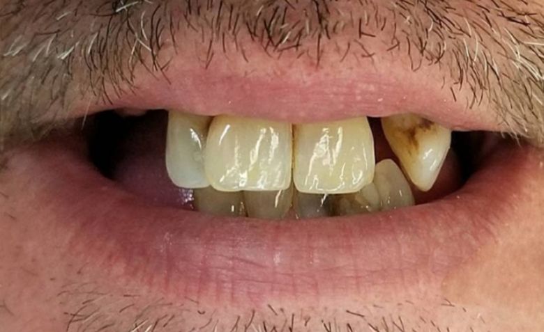 Decayed and broken top teeth