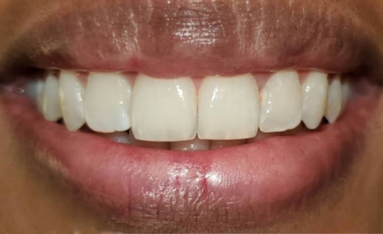 Flawlessly repaired top teeth