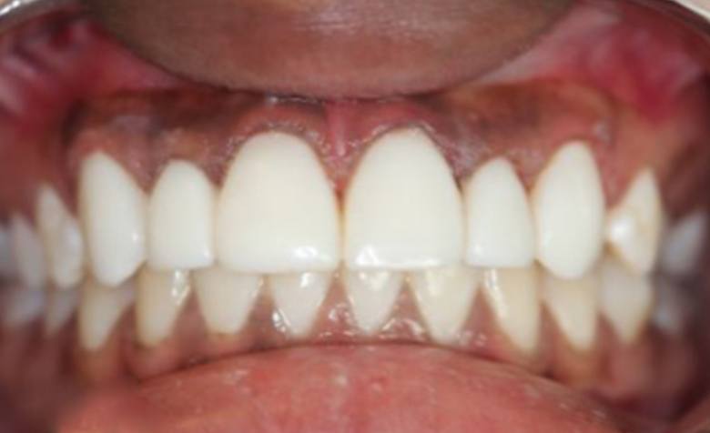 Flawlessly repaired top teeth