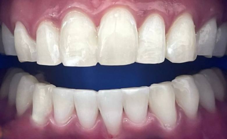 Flawlessly repaired top teeth