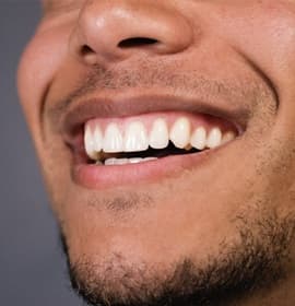 man smiling teeth