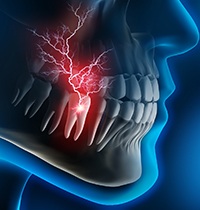 types of dental implants in Brampton on blue background