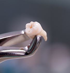 Dental forceps holding an extracted tooth