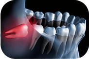 Illustration of impacted wisdom tooth