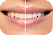 Close up of smile before and after teeth whitening