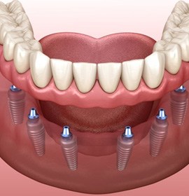 Illustration of implant dentures for lower dental arch