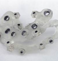 examples of guided dental implant technology in Brampton