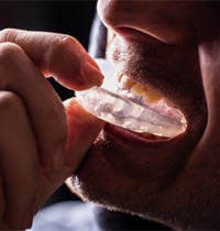 a man wearing nightguards for bruxism to protect dental implants 