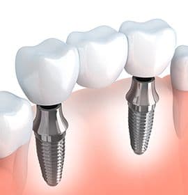 Animation of implant supported fixed bridge