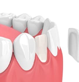 Porcelain veneers