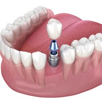 Dental implant in Brampton