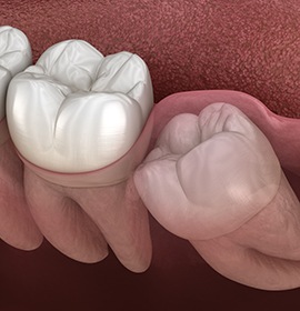 A 3D illustration of an impacted wisdom tooth
