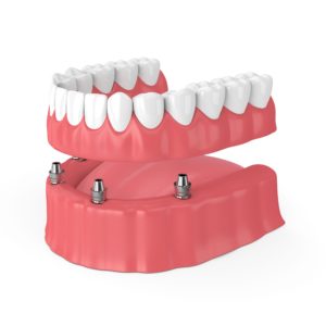 rendering of implant-retained dentures