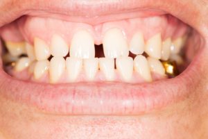 person with gap in teeth