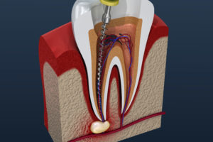 rendering of an endodontic procedure