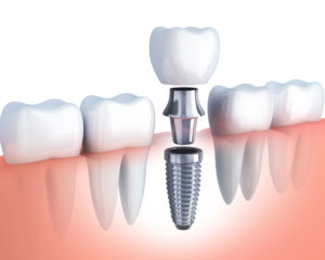 3d rendering of dental implant