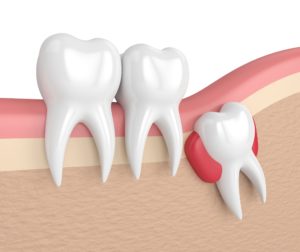 rendering of an impacted tooth