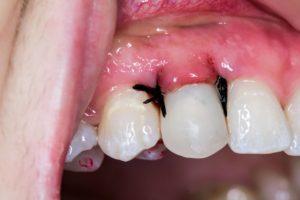 stitches in teeth