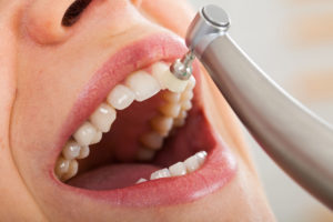 patient's tooth being polished