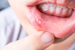 Canker sore on inner lip