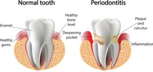 good vs bad tooth comparison