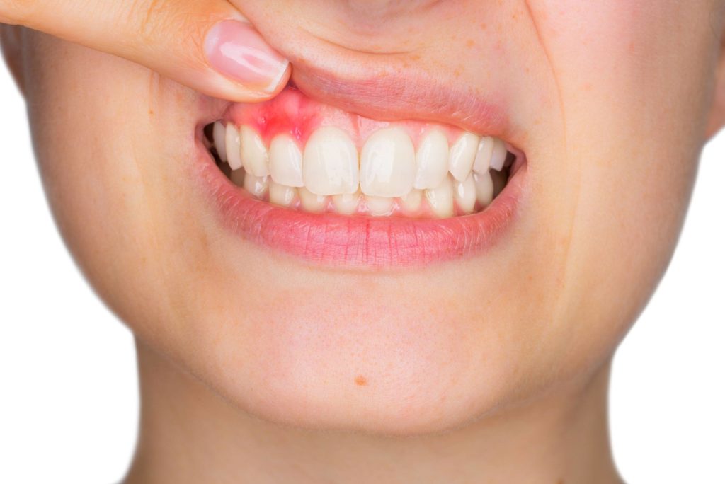 pathological fear of gums pathological fear of gums