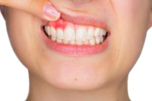 Inflamed Gums