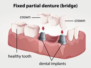 Example of Dental Implant Bridge