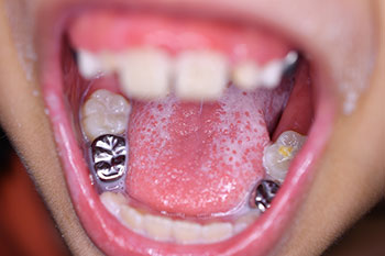 silver crown teeth