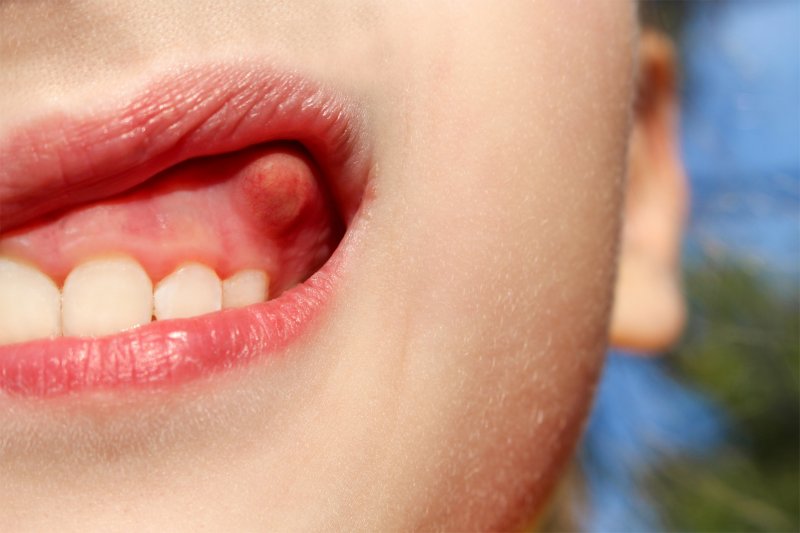 person with bump on gums