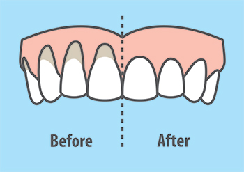 fix low gums grafting alloderm brampton dentist