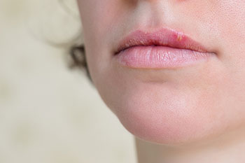 how to fix cold sores brampton dentist