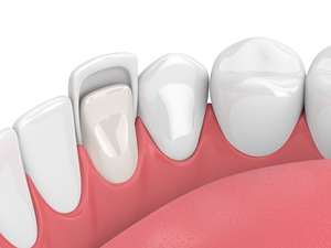 Render of tooth with a veneer placed on it