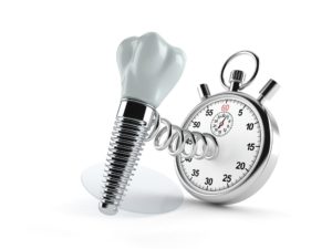 Dental implant and stopwatch